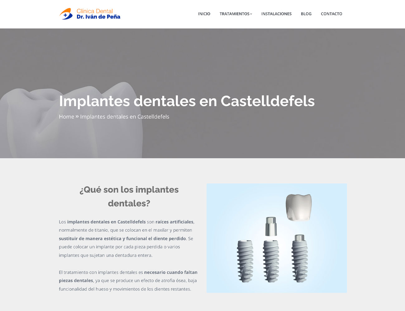 colocar más implantes dentales